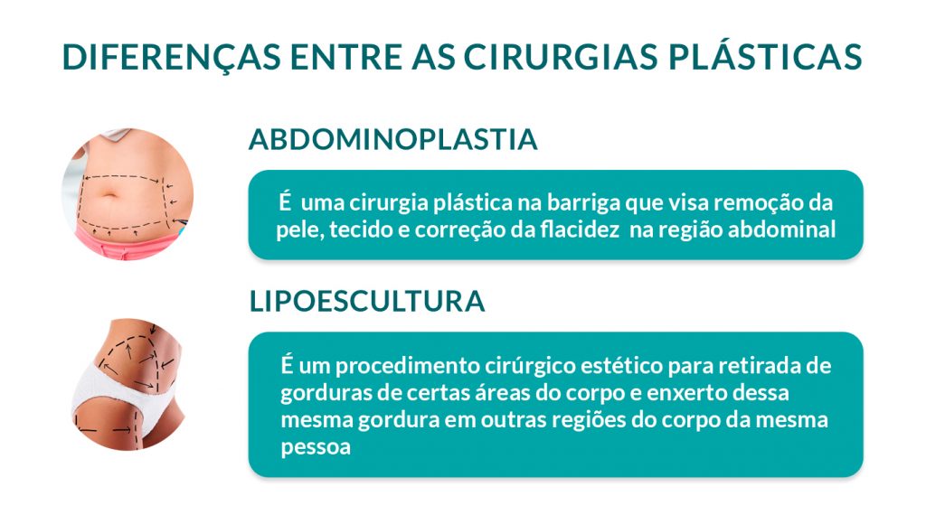 Abdominoplastia e lipoescultura: qual a diferença entre os procedimentos? Abdominoplastia e lipoescultura: qual a diferença entre os procedimentos?