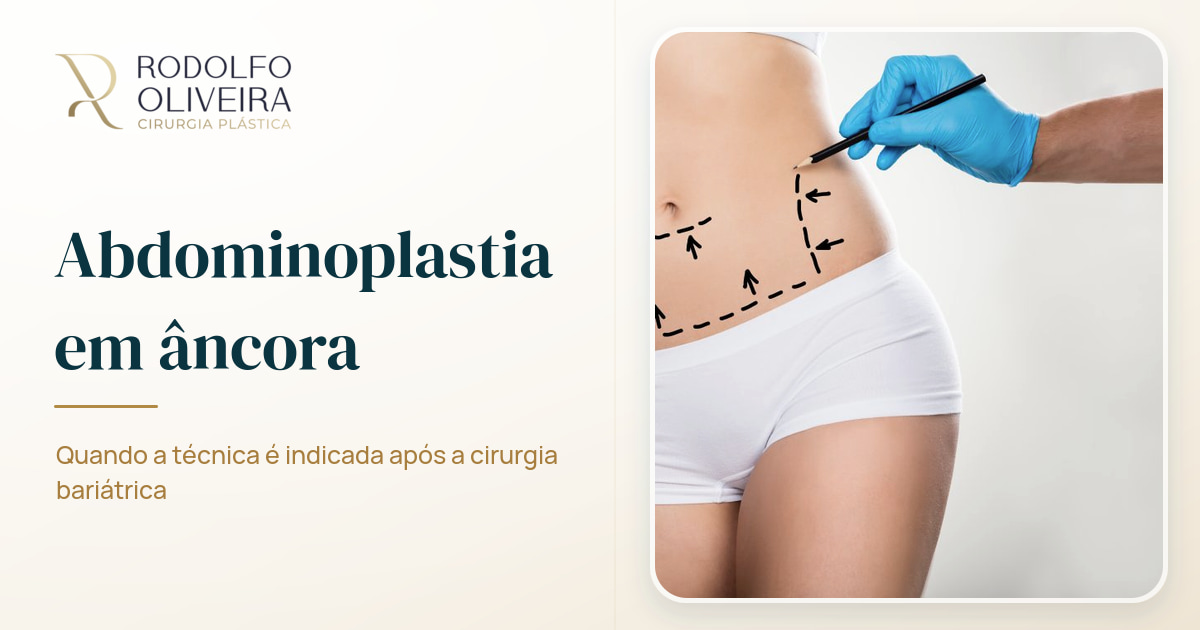 Imagem de capa do artigo Abdominoplastia em âncora é recomendada após cirurgia bariátrica?