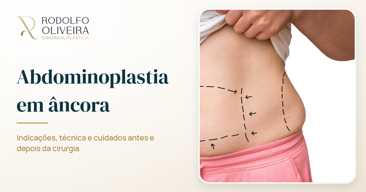 Imagem de capa do artigo Tire suas dúvidas sobre a abdominoplastia em âncora