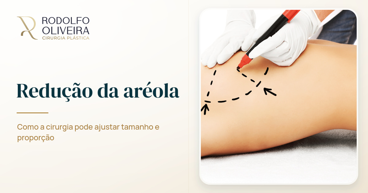 Imagem de capa do artigo É possível reduzir o tamanho da aréola dos seios com cirurgia?