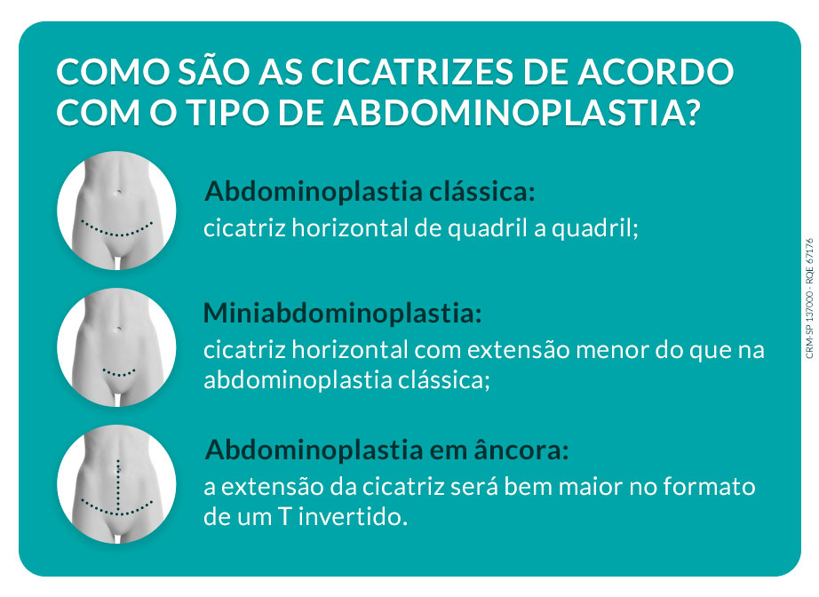 Como são as cicatrizes de acordo com o tipo de abdominoplastia? Cicatriz abdominoplastia: como fica após a cirurgia?