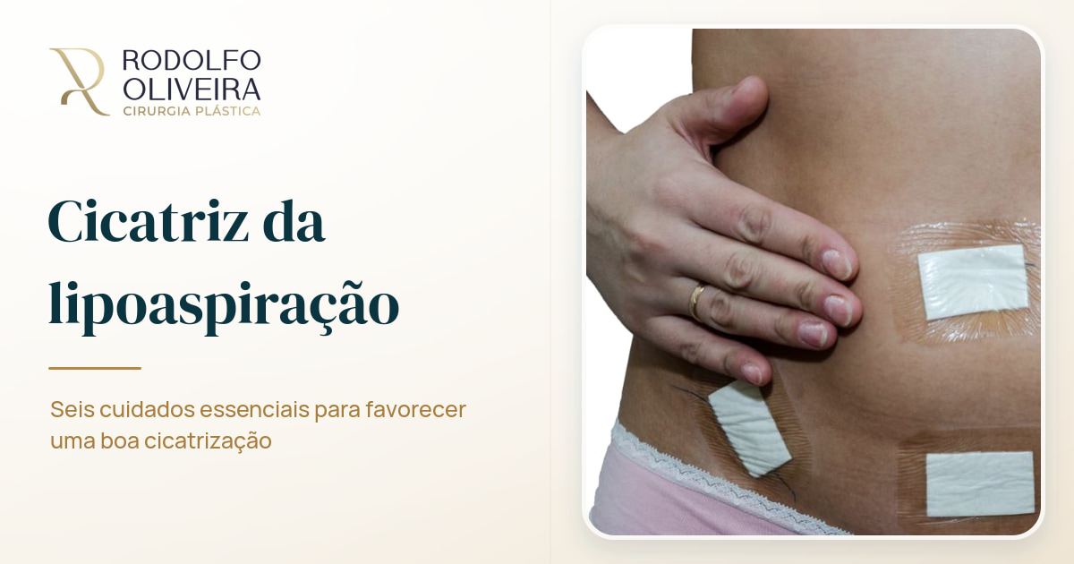 Imagem de capa do artigo Cicatriz lipo: 6 cuidados importantes