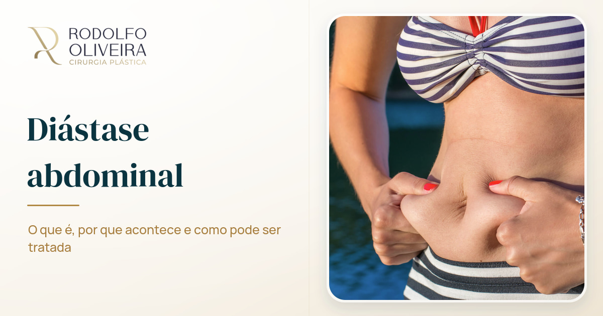 Imagem de capa do artigo Você sabe o que é diástase?