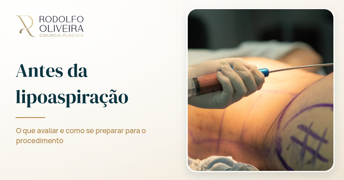 Imagem de capa do artigo O que você deve saber antes de fazer uma lipoaspiração?