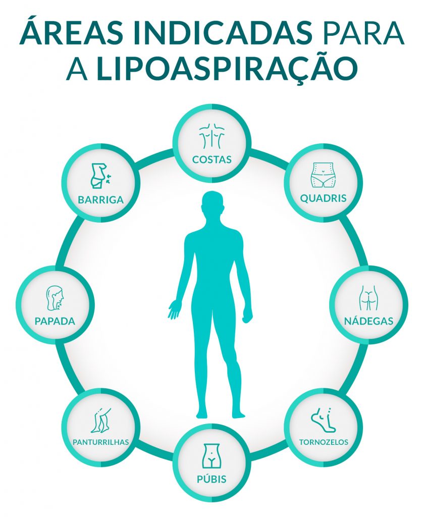 Áreas indicadas para a lipoaspiração Lipo nos flancos: solução para se livrar dos pneuzinhos