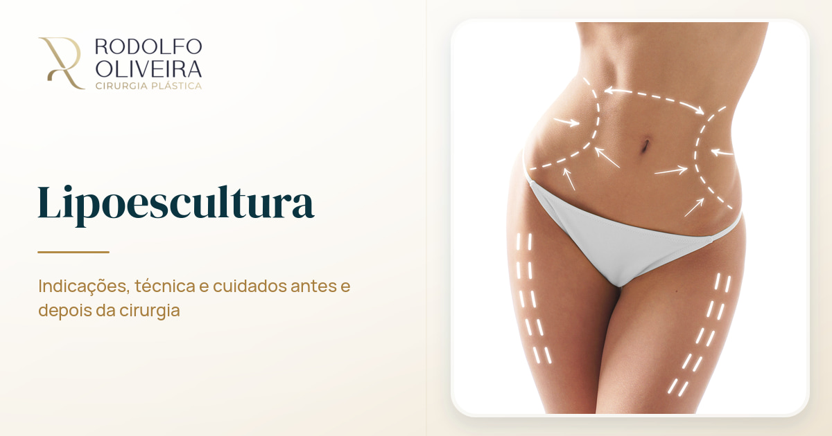 Imagem de capa do artigo Lipoescultura: Entenda a técnica