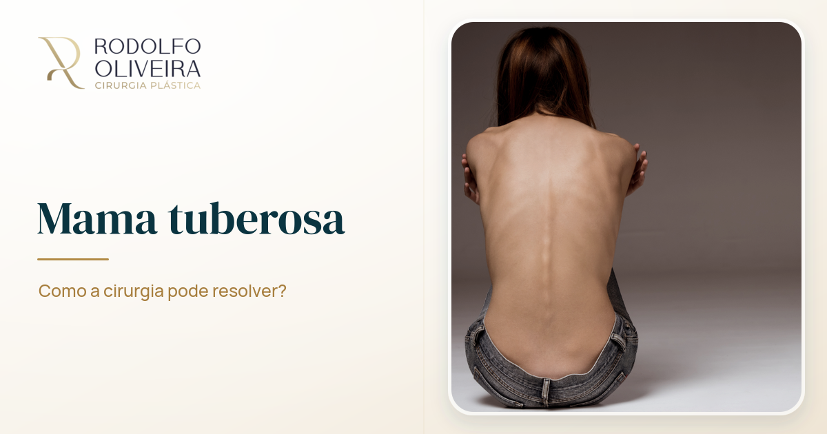 Imagem de capa do artigo Mama tuberosa: como a cirurgia pode resolver?