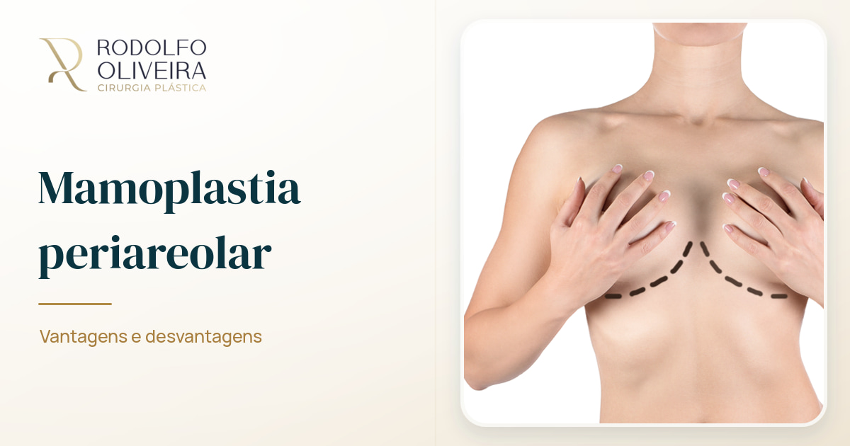 Imagem de capa do artigo Mamoplastia periareolar: vantagens e desvantagens