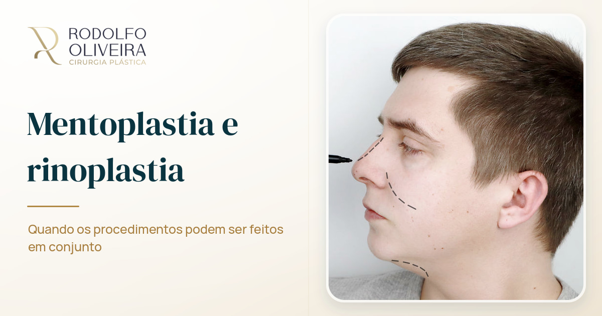 Imagem de capa do artigo Mentoplastia só deve ser feita em conjunto com rinoplastia?
