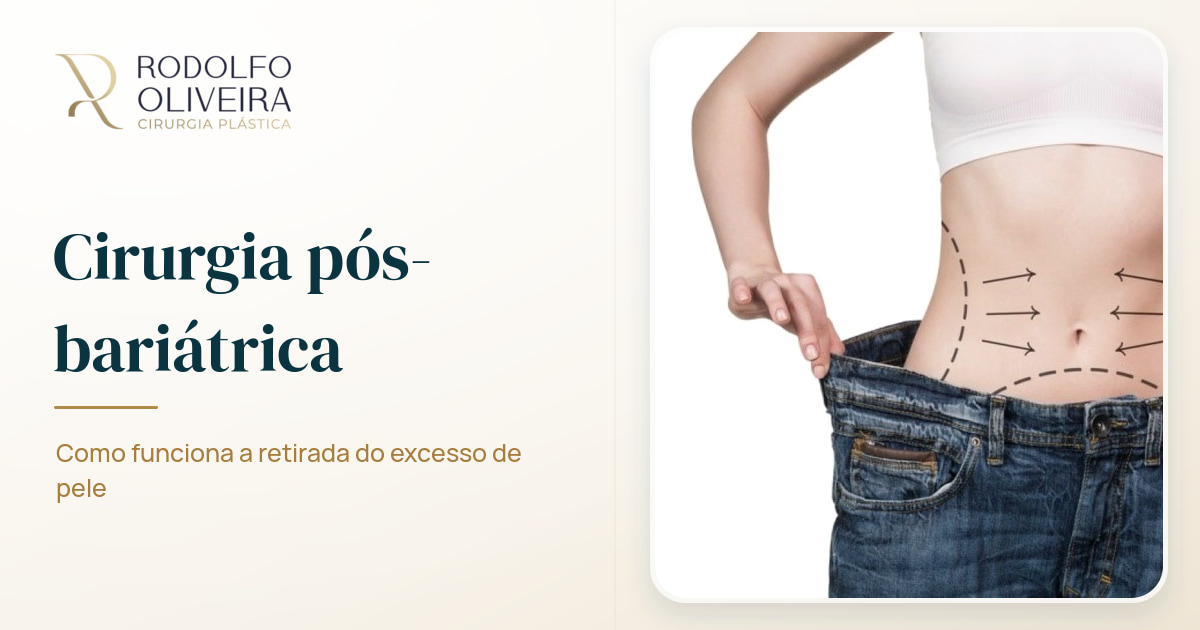 Imagem de capa do artigo Você sabe como é a cirurgia pós-bariátrica?
