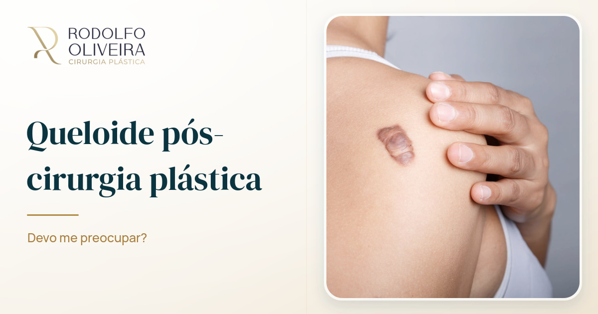 Imagem de capa do artigo Queloide pós-cirurgia plástica: devo me preocupar?