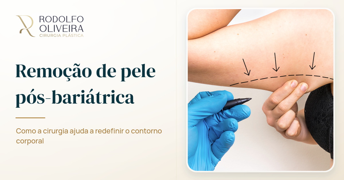 Imagem de capa do artigo Como é feita a remoção do excesso de pele pós-bariátrica?