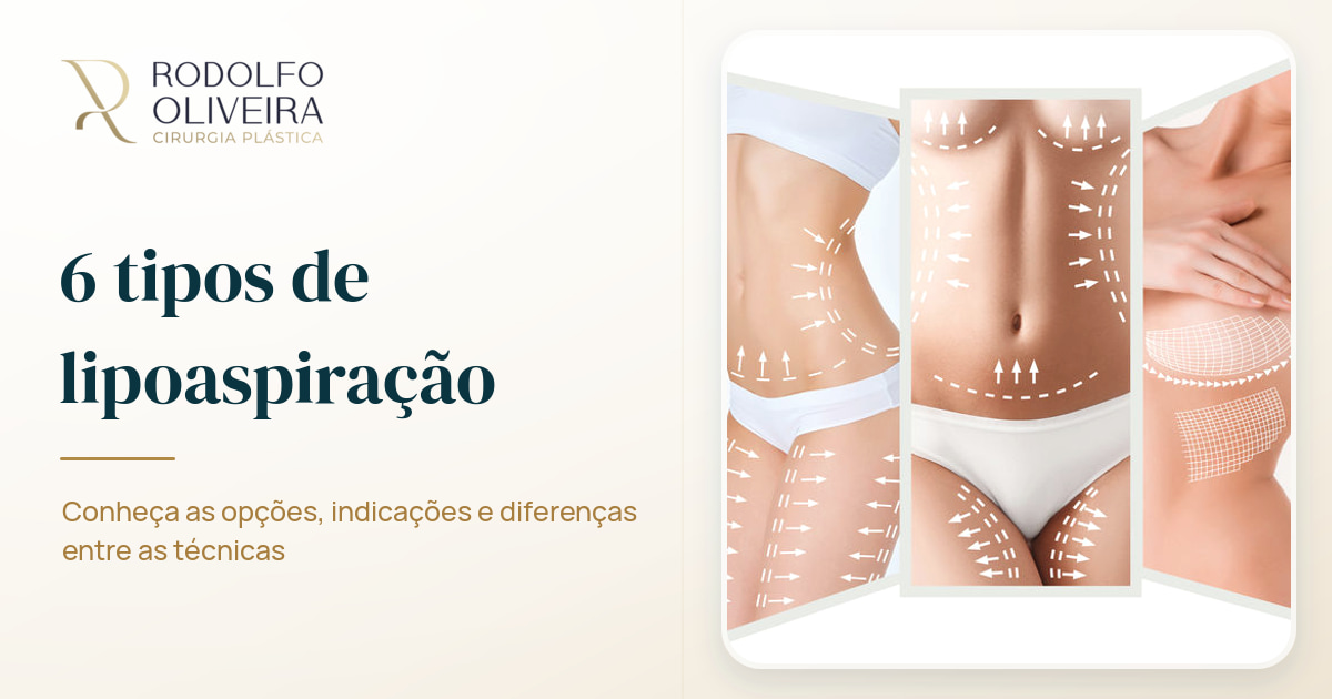 Imagem de capa do artigo 6 tipos de lipoaspiração que você deve conhecer