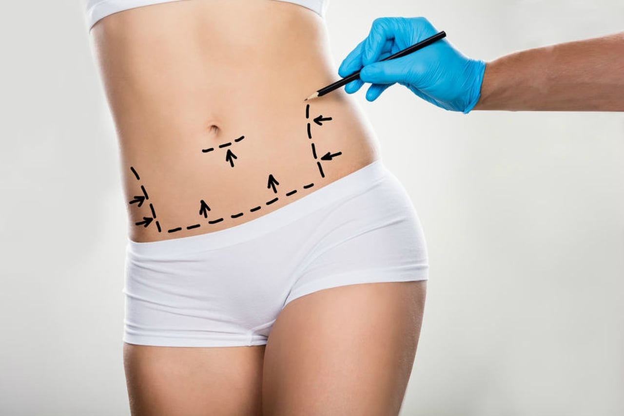 ­7 coisas que você precisa saber antes de fazer uma abdominoplastia