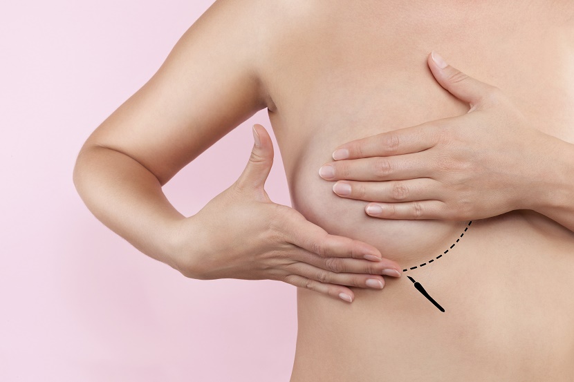 Como funciona a cirurgia de redução das mamas
