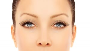Blefaroplastia