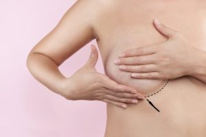 Mamoplastia e mastopexia