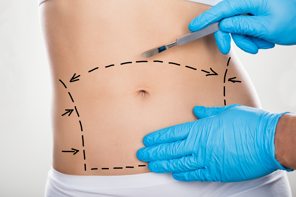 Por que é necessário usar cinta modeladora após a abdominoplastia?