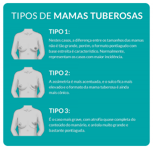 Esse problema costuma ser dividido em 3 tipos de mamas tuberosas: Tipo 1 Na mama tuberosa Tipo 1,  a diferença entre os tamanhos das mamas não é tão grande, porém, o formato pontiagudo com base estreita é característico. Normalmente, representam os casos com maior incidência. Tipo 2 Neste caso, a assimetria é acentuada, e o sulco fica mais elevado e o formato da mama tuberosa é ainda mais cônico. Tipo 3 É o caso mais grave, com atrofia quase completa do conteúdo do mamário, e aréola bastante pontiaguda.